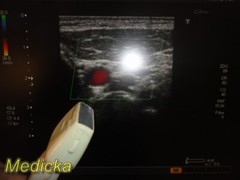 2012 Toshiba PLT-604AT Linear Array Ultrasound Transducer Probe, 6 Mhz ~ 30276