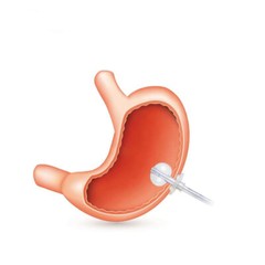 New High Quality Disposable Silicone Gastrostomy Feed PEG Tube Gastrostomy Tube