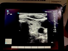 SonoSite Edge II Ultrasound | Factory Refurb | Probe Choice I 1-Year Warranty