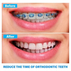 1040 Pcs/Pack Orthodontic Dental Rubber Elastic Braces Ligature Ties 45 Types