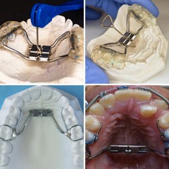 Orthodontic Expansion Teeth Rapid Palatal Expander Dental Hydrax Screw Split Key
